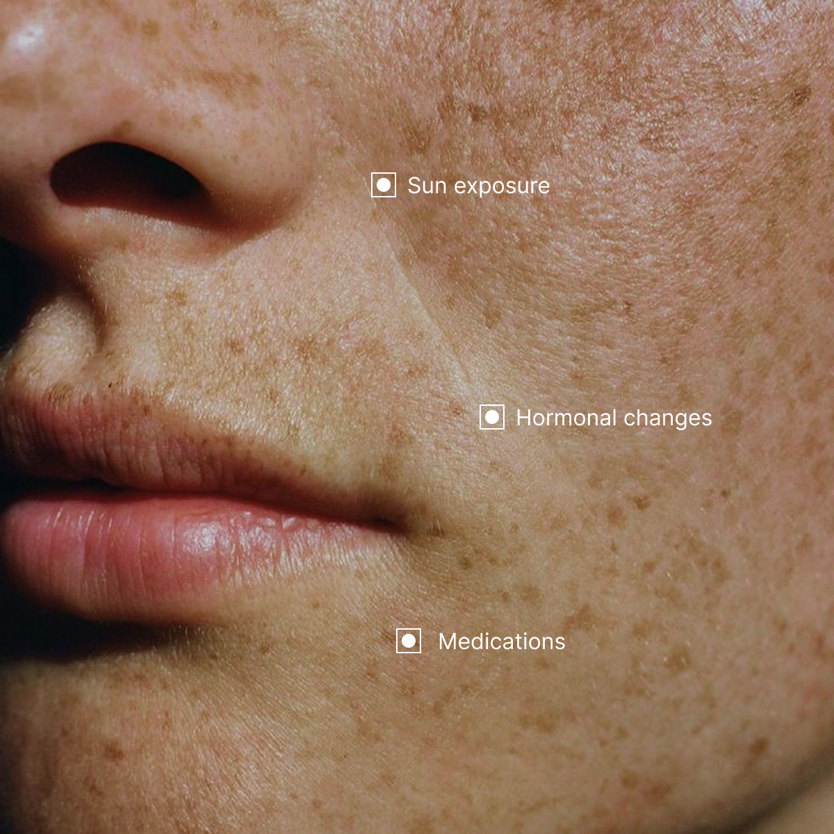 Symptoms and causes of Hyperpigmentation