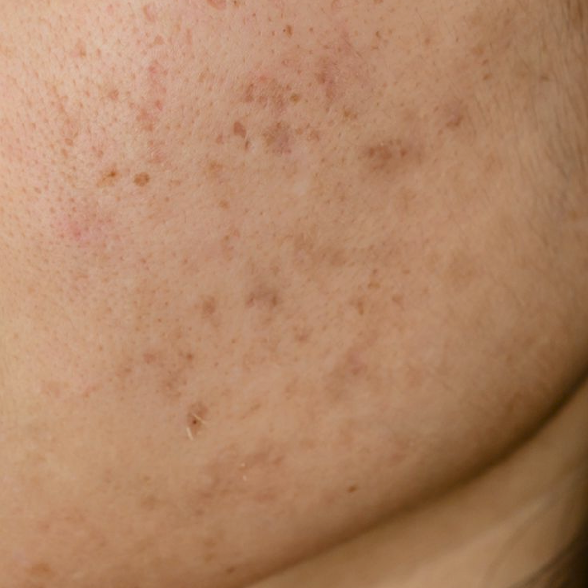 Acne scars form when acne lesions penetrate deep into the skin, damaging skin tissue and leaving behind scar tissue.