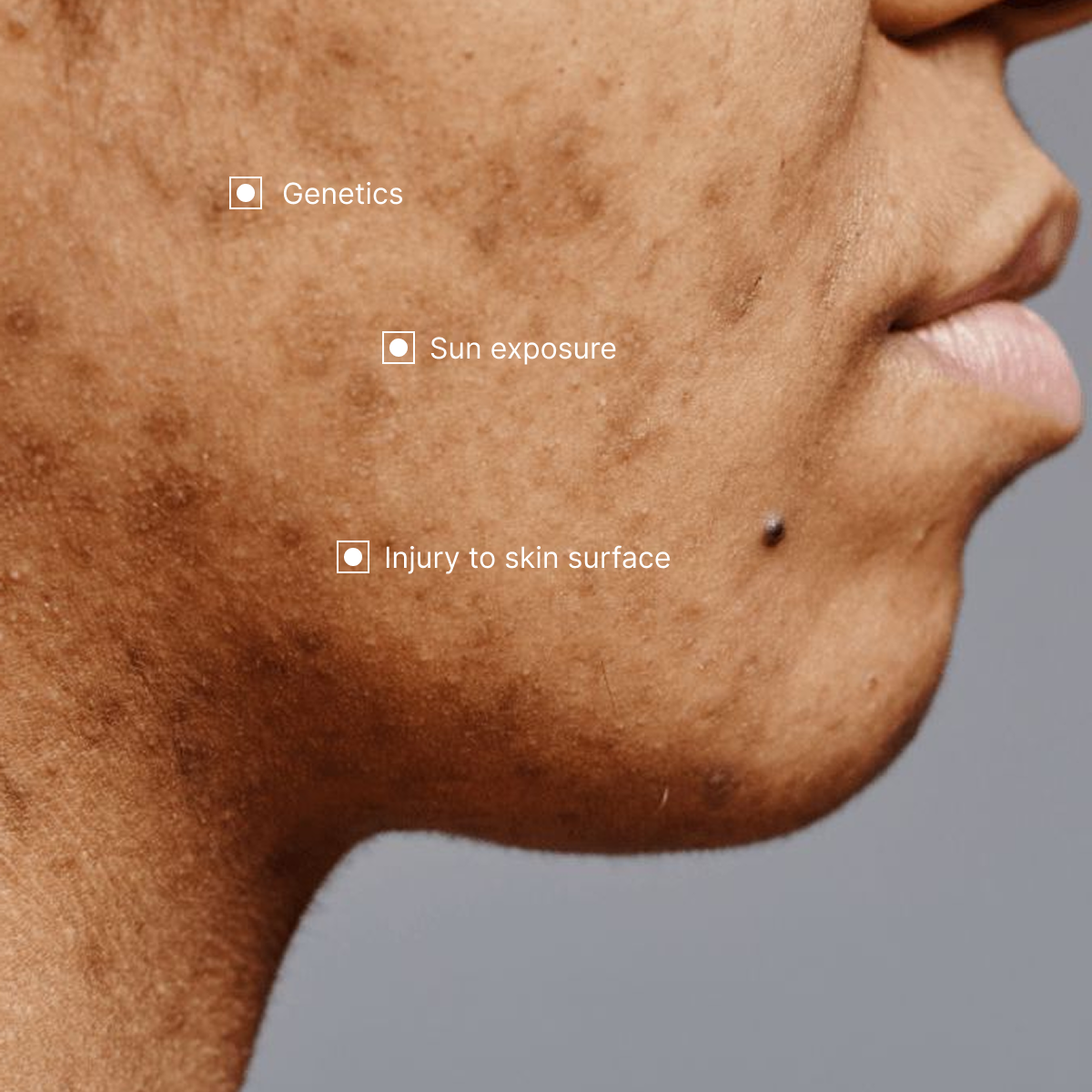 Symptoms and causes of Acne