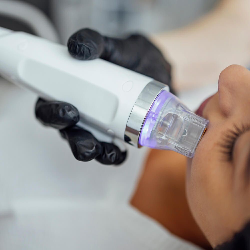 Microneedling & RF Microneedling