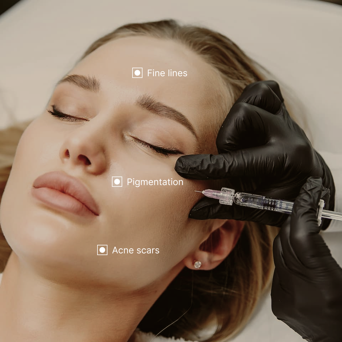 By harnessing your body's growth factors, PRP effectively promotes collagen synthesis, enhancing elasticity and providing a natural, youthful glow.