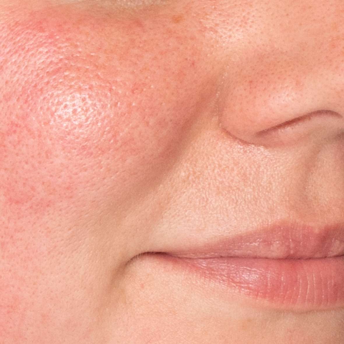 Symptoms and causes of Melasma