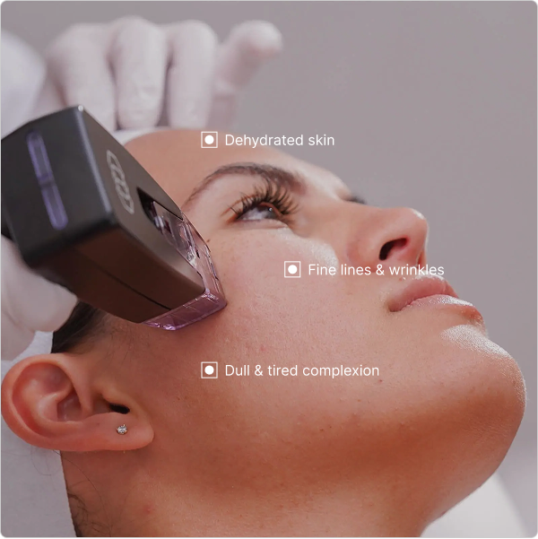 Morpheus8 offers deeper penetration compared to traditional RF devices, allowing effective remodeling of subdermal tissues and adipose layers for dramatically lifted, smoother, and younger-looking skin.