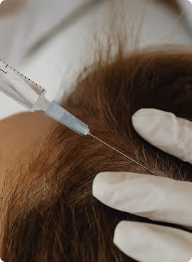 Hair Restoration with PRP