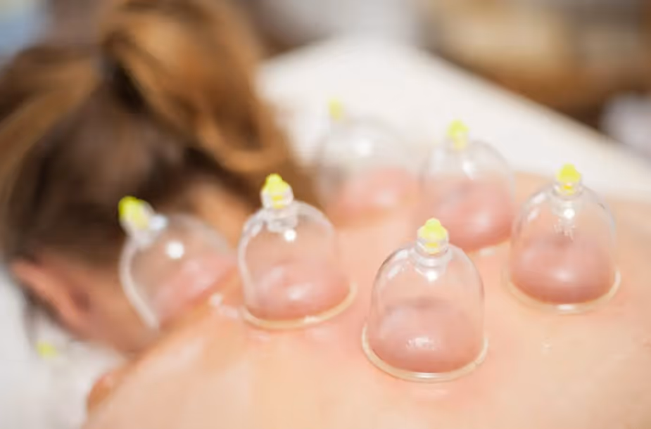 cupping physical therapy