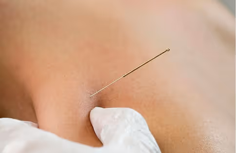 dry needling