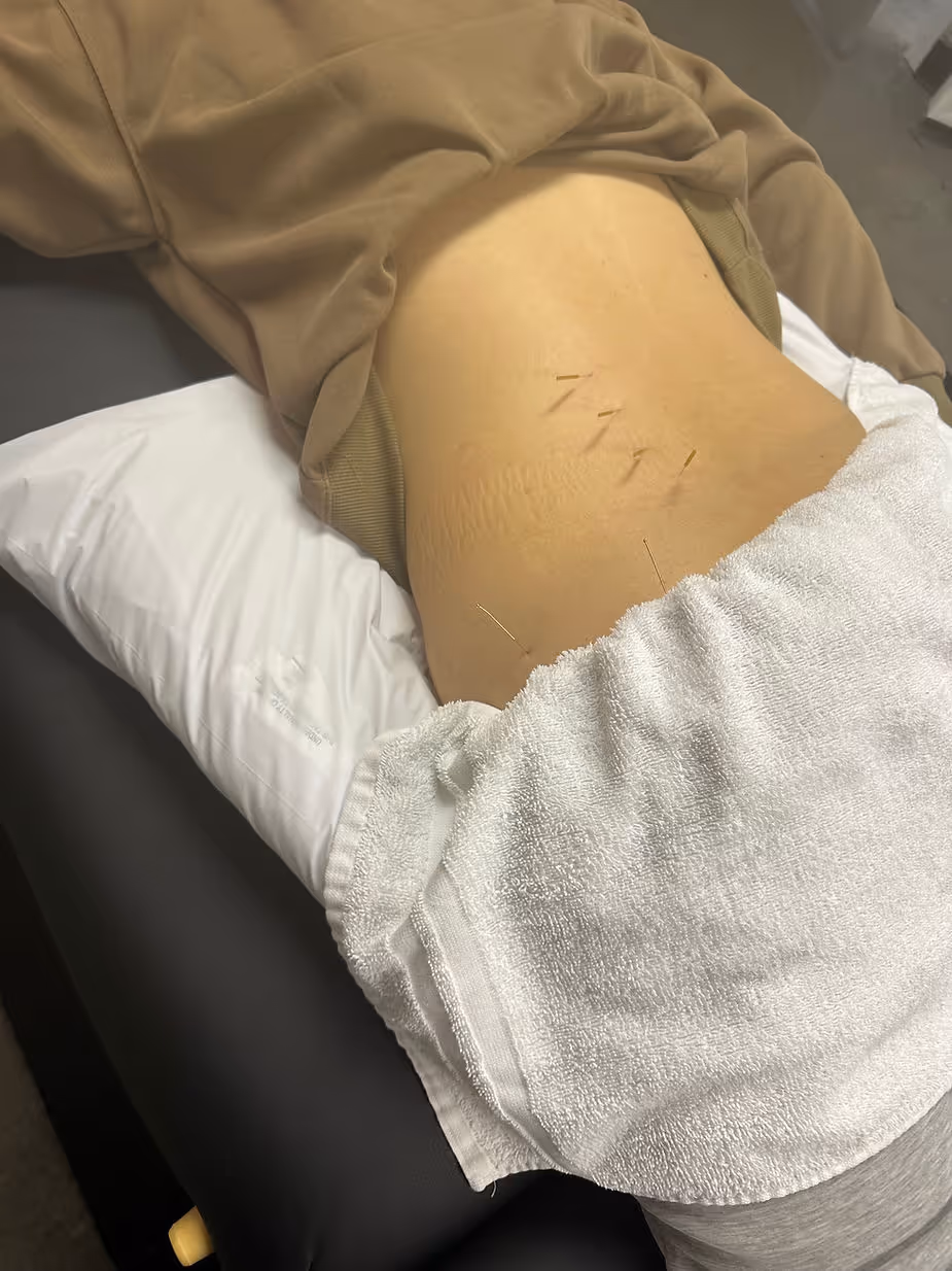 dry needling