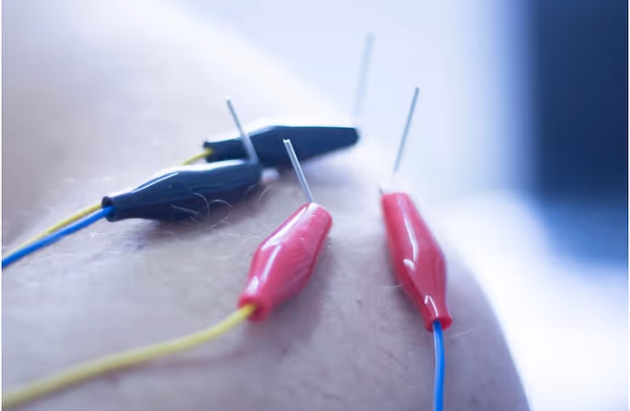 dry needling