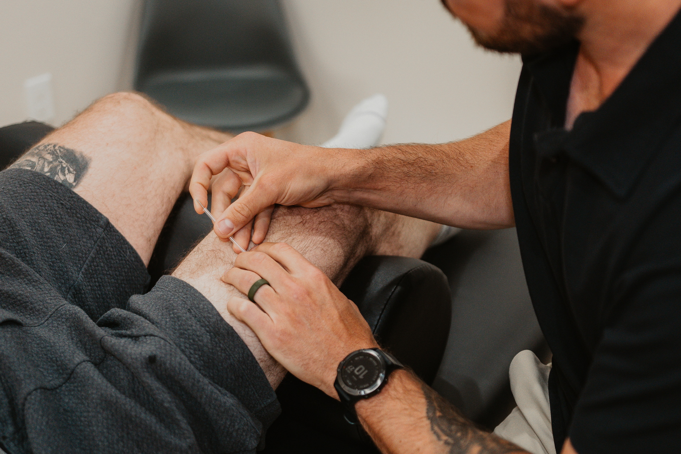 Person receiving acupuncture treatment on a hairy leg by a practitioner wearing a watch and black shirt.