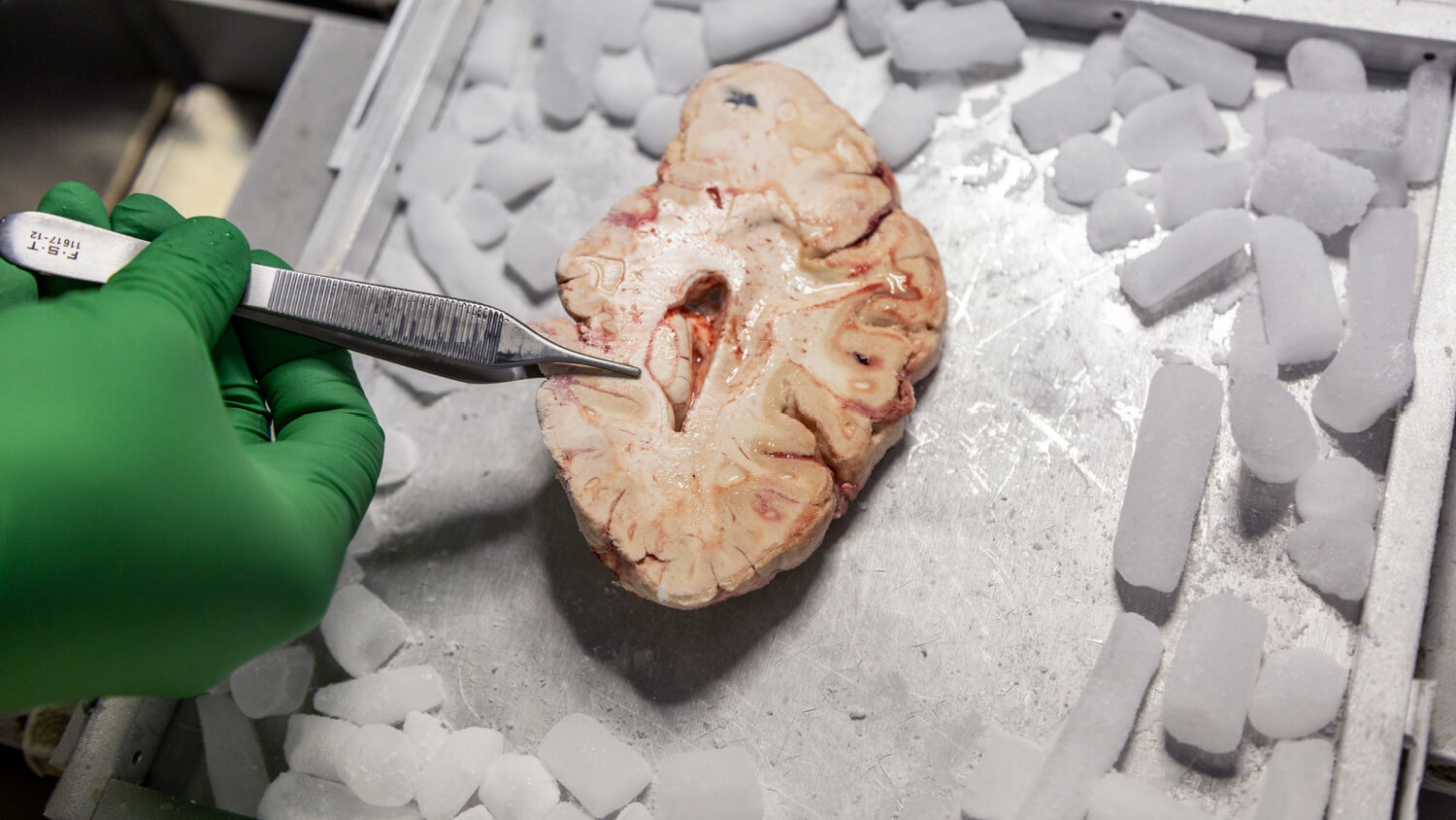 Gloved hand using a scalpel to dissect a cross-section of a human brain specimen on dry ice.