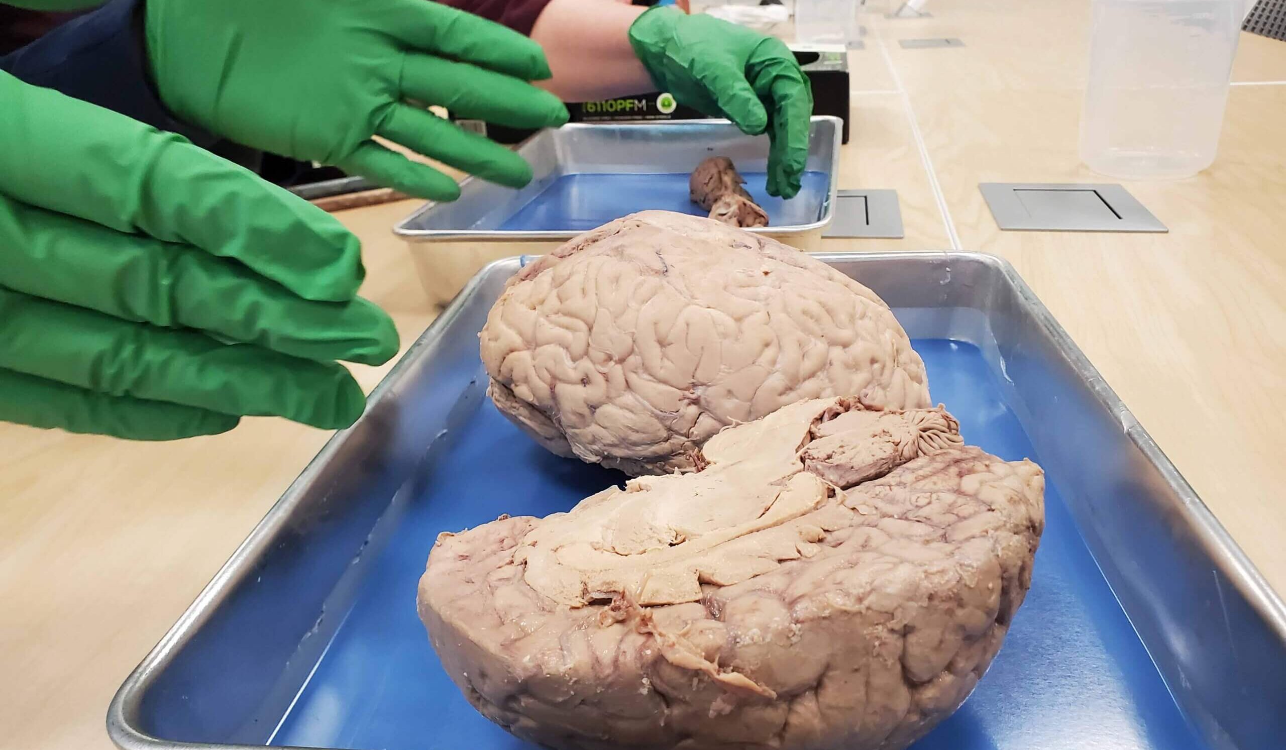 Gloved hands examining a human brain specimen in a blue dissection tray during anatomy education.