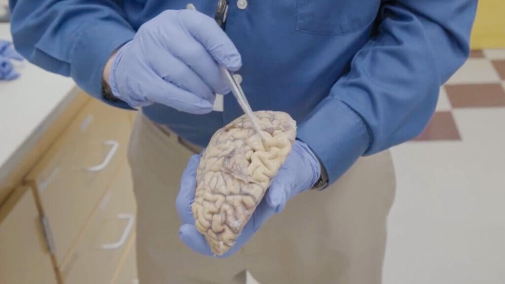 Researcher in blue gloves and coat examining human brain specimen with pointer