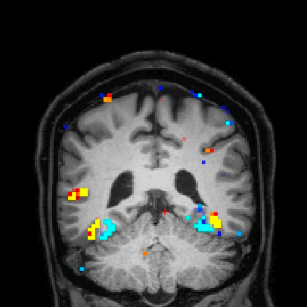 Brain MRI scan with colorful activation map overlay showing neural activity areas