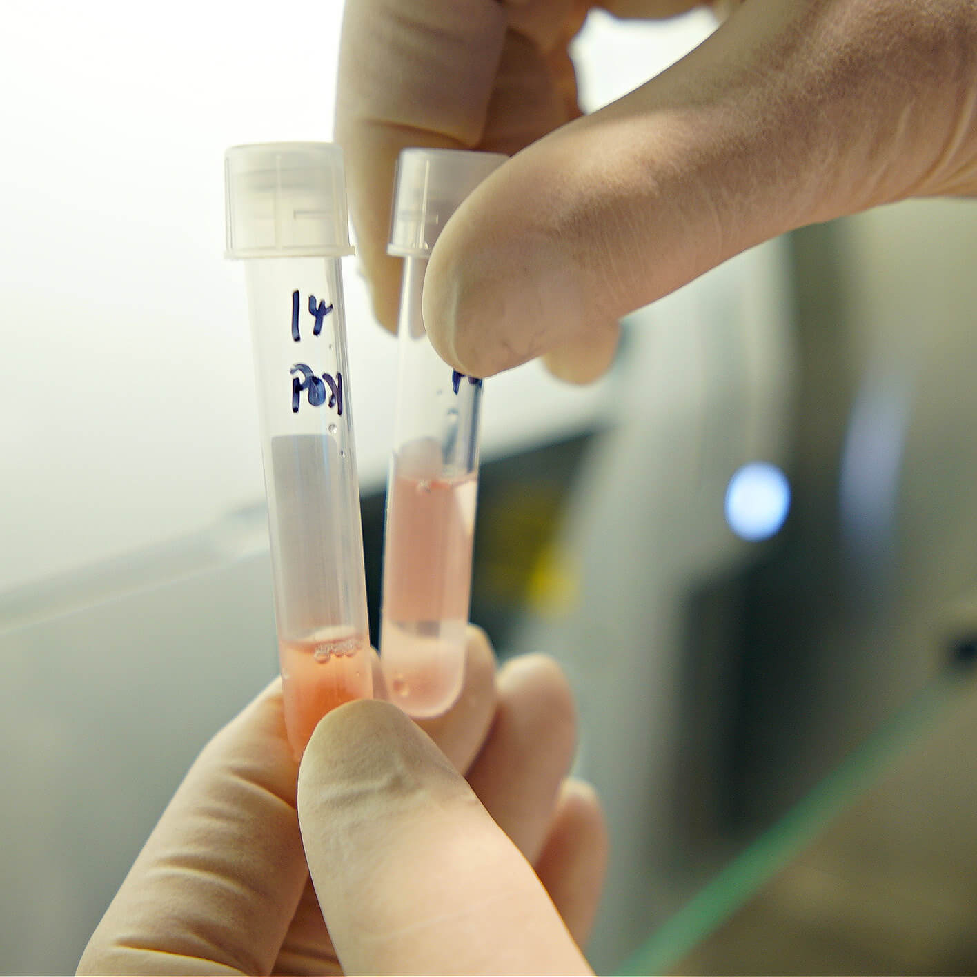 Person holding labeled laboratory test tubes containing reddish liquid samples in medical setting