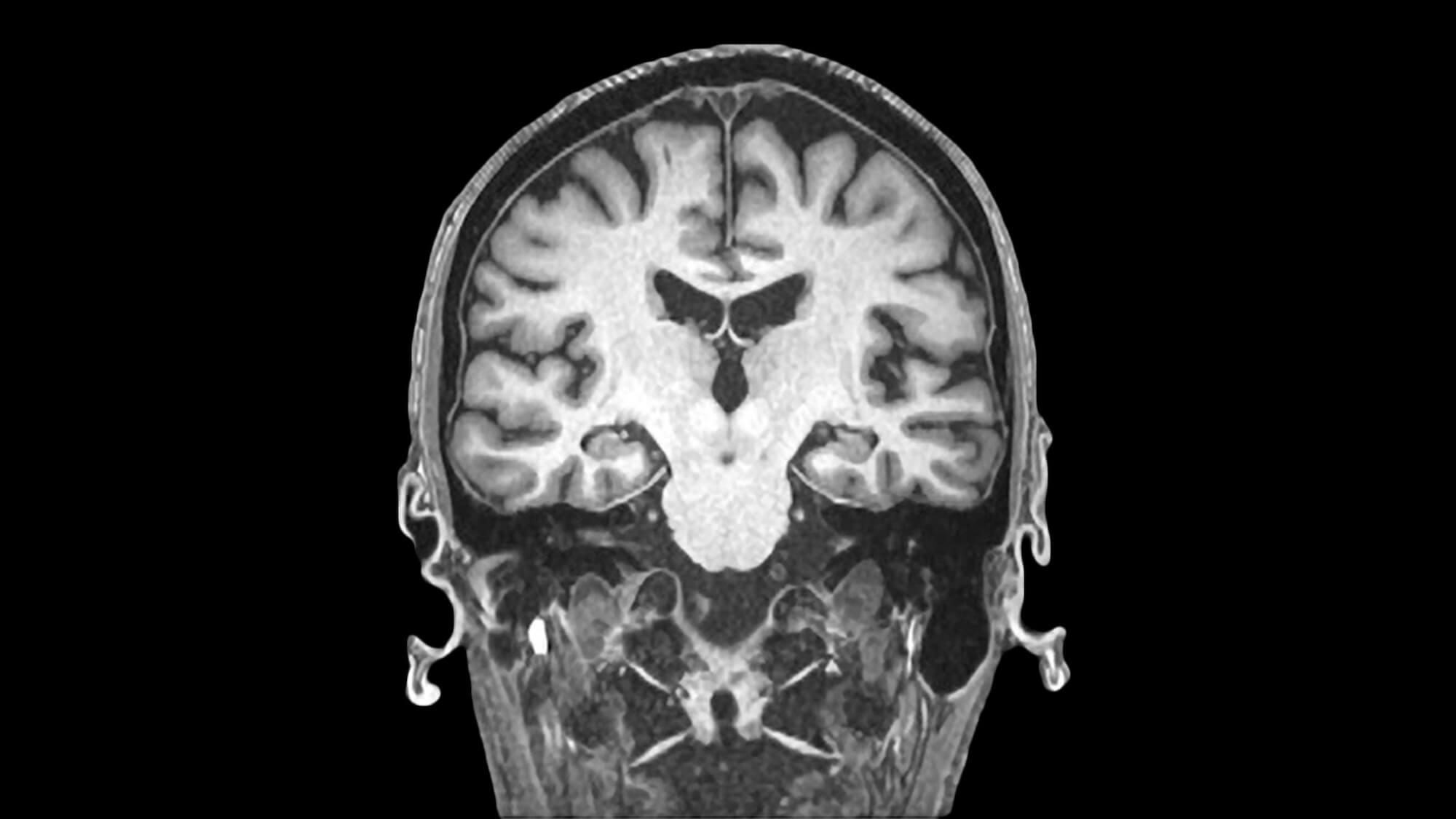 Coronal MRI brain scan showing cerebral hemispheres and ventricles in grayscale imaging