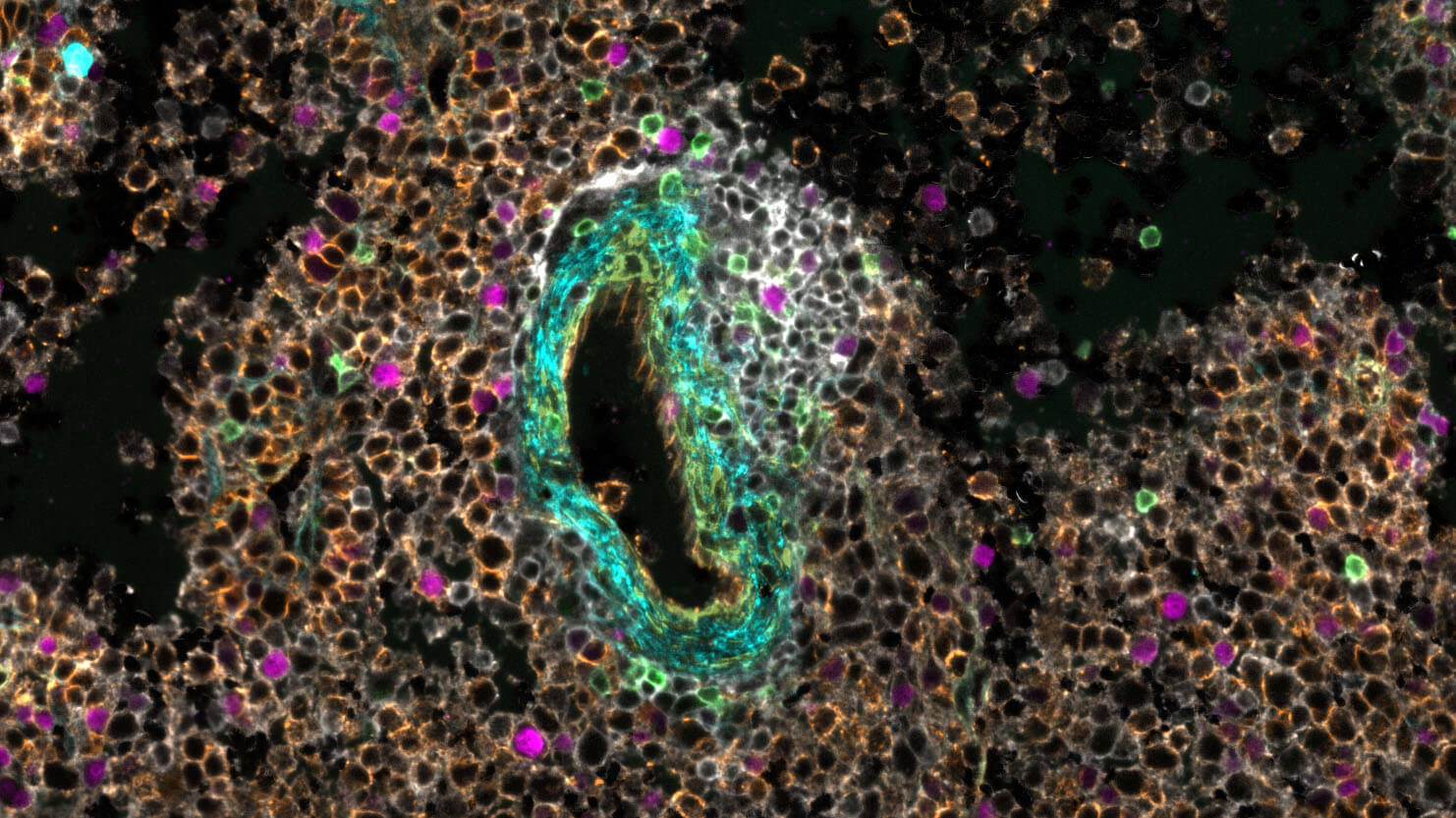 Plasmactoma cells with cyan and green highlighted structure in center