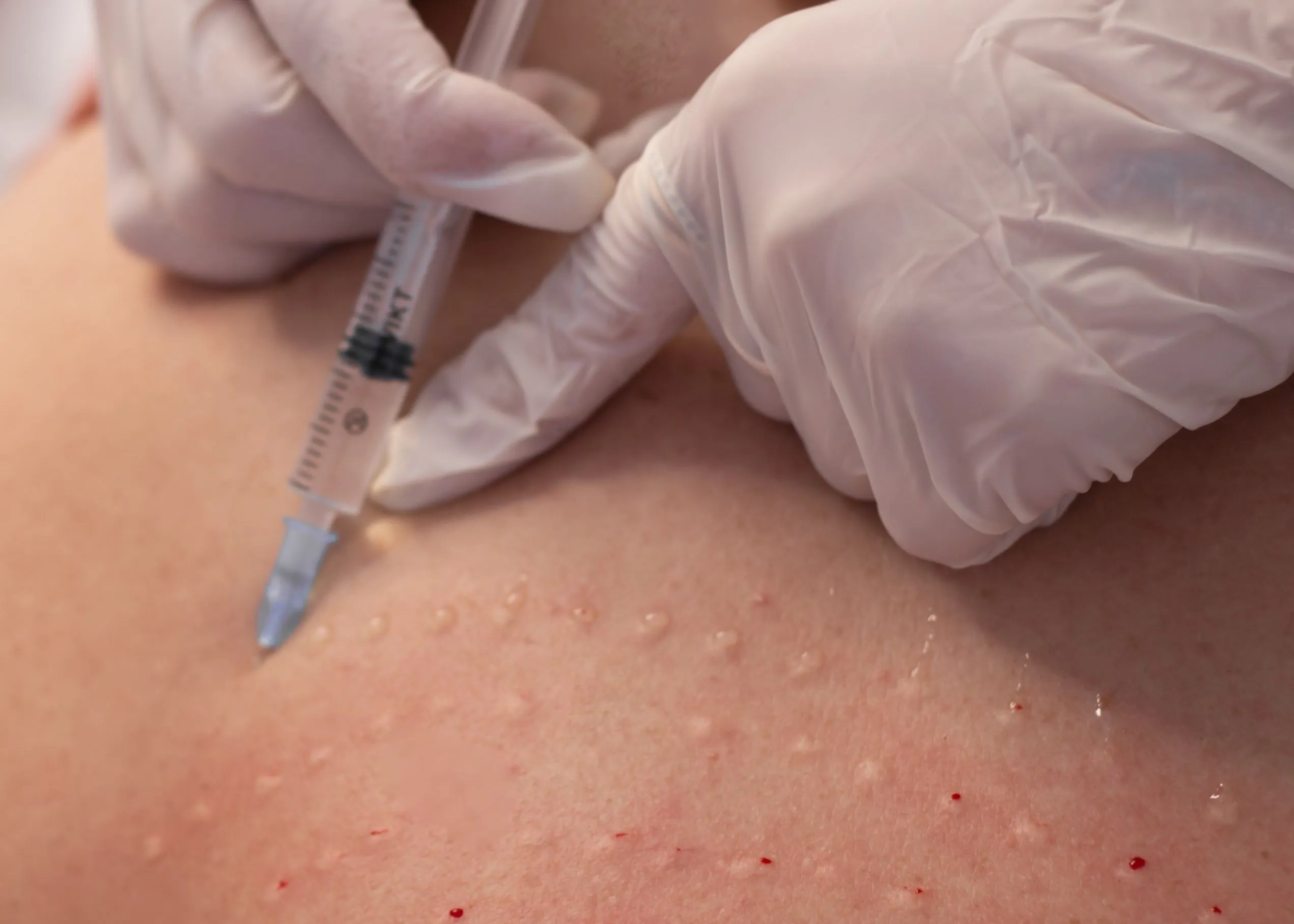 A person getting a Lipo C injection.