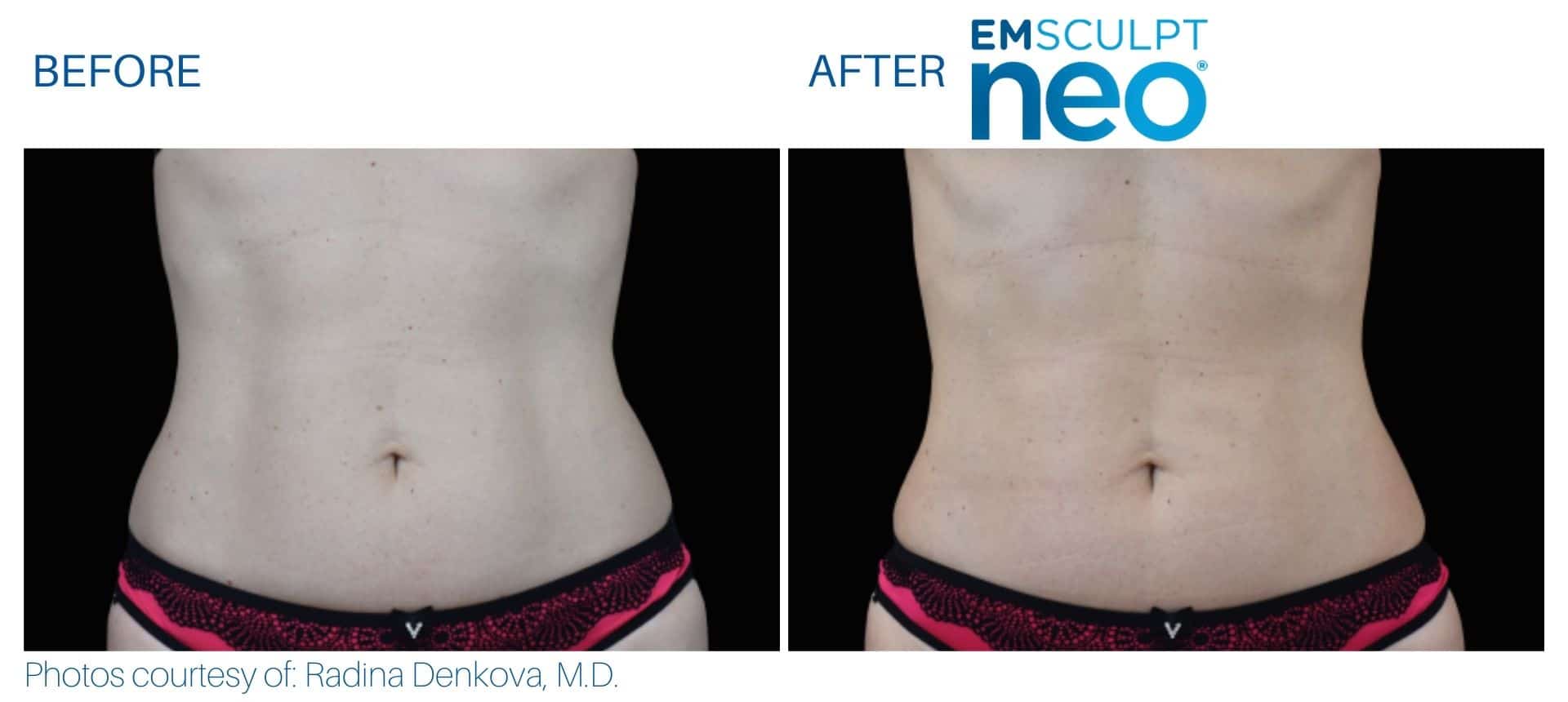 Side-by-side before and after photos showing a woman's abdomen with a slightly slimmer and more toned appearance after EMSculpt Neo treatment.