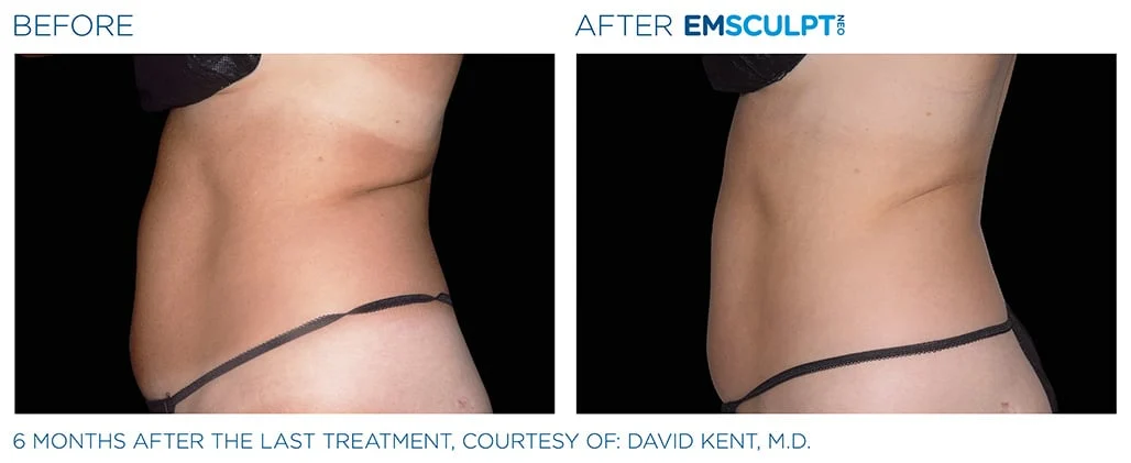 Side-by-side before and after images showing abdominal area with visibly reduced fat and smoother skin after EMSculpt NEO treatment.