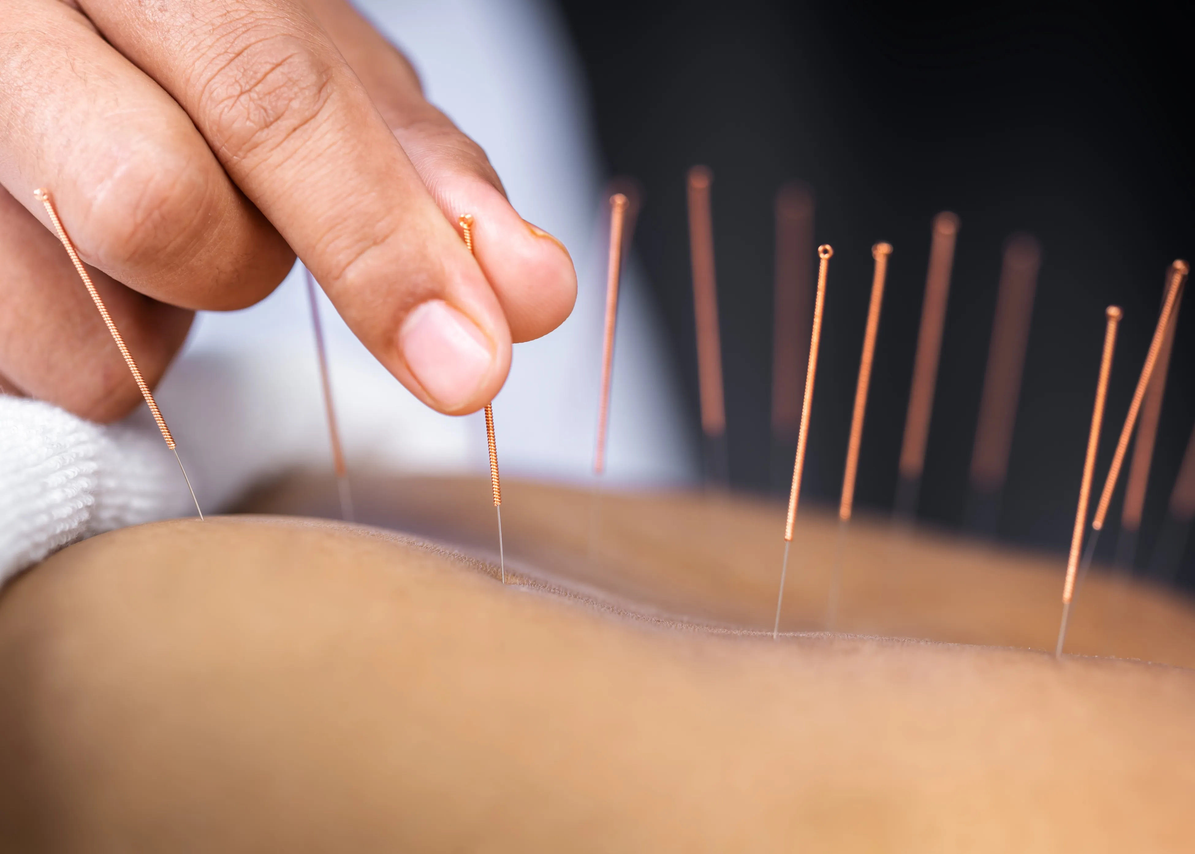 Acupuncture Largo FL