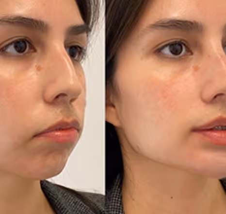 Close-up comparison of a woman's face before and after skin treatment, showing reduced dark spots and smoother skin tone.