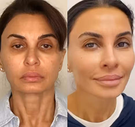 Side-by-side comparison of a woman's face before and after cosmetic treatment, showing smoother skin and enhanced features after.