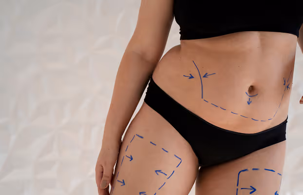 Woman's torso and thigh with blue surgical markings on stomach and leg, wearing black underwear.