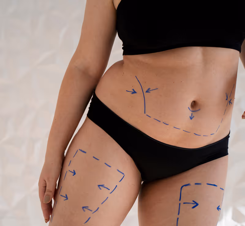 Woman's torso and upper legs with blue surgical markings for body contouring or cosmetic surgery.