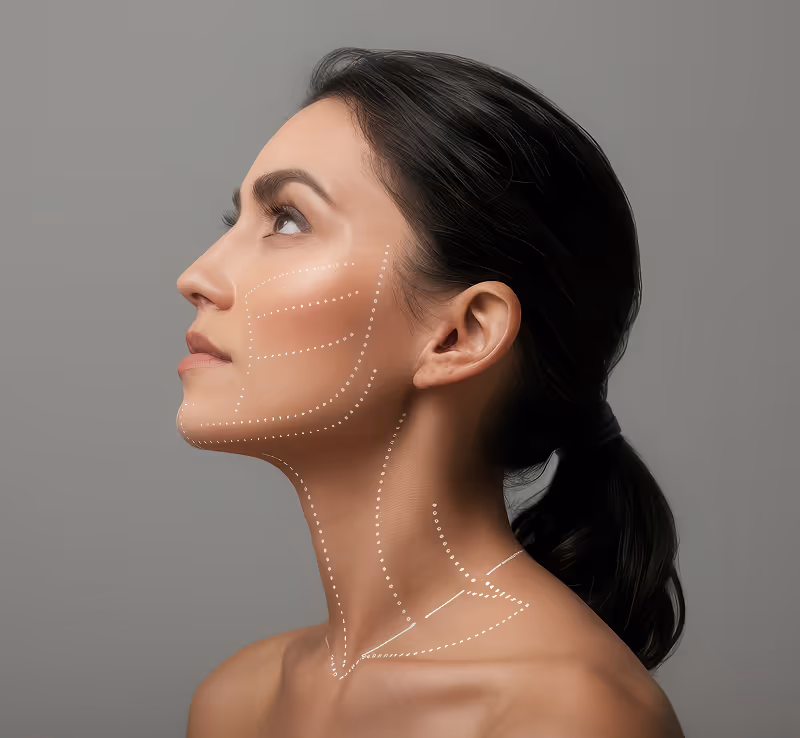 Profile of a woman with hair tied back showing dotted lines on face and neck for cosmetic treatment.