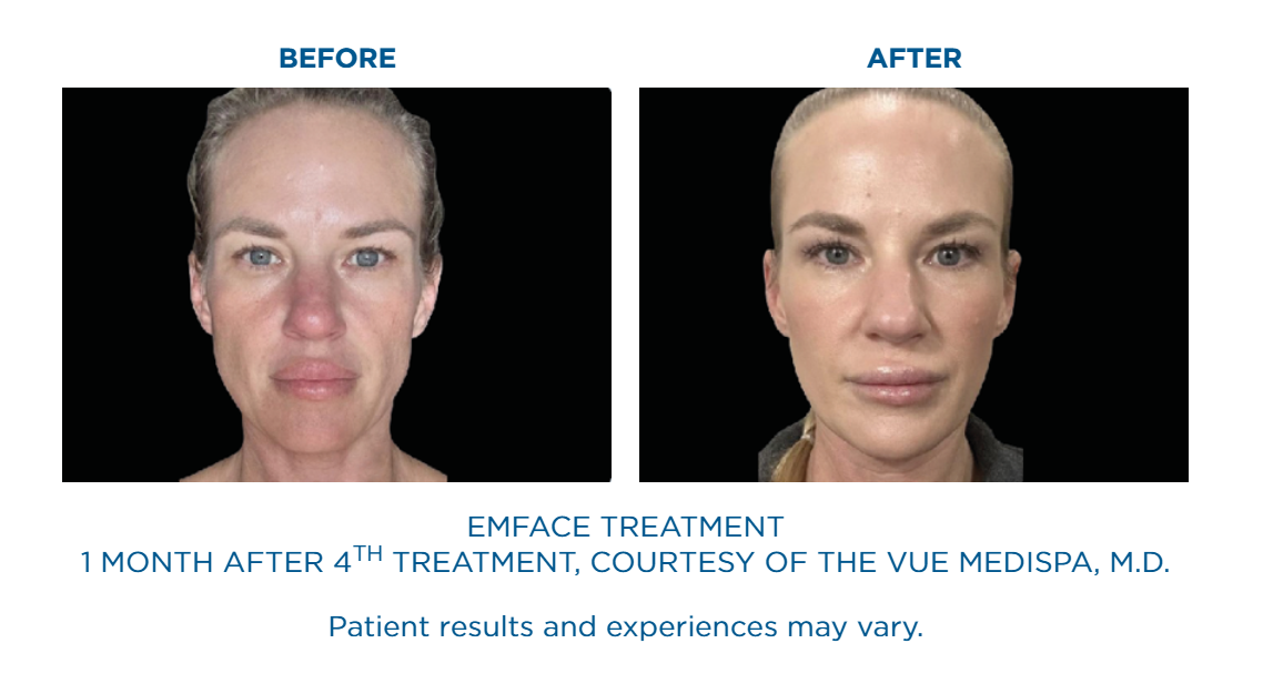 Side-by-side before and after photos of a woman’s face showing skin improvement one month after the fourth EMFACE treatment.