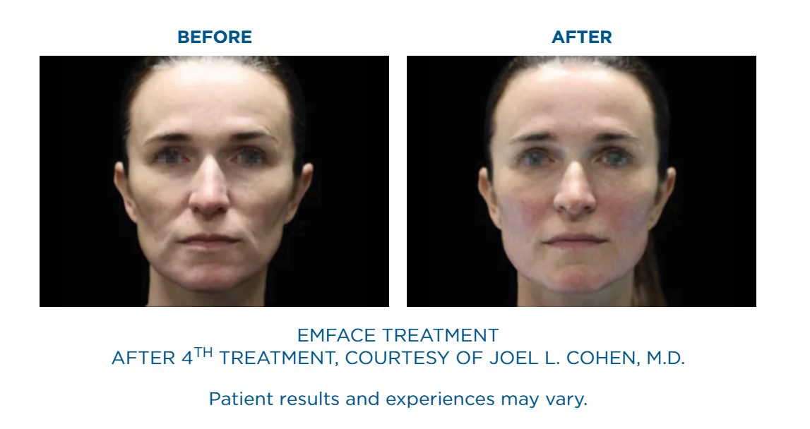 Side-by-side before and after photos of a woman's face showing results after four Emface treatments, with smoother skin and reduced facial lines in the after image.