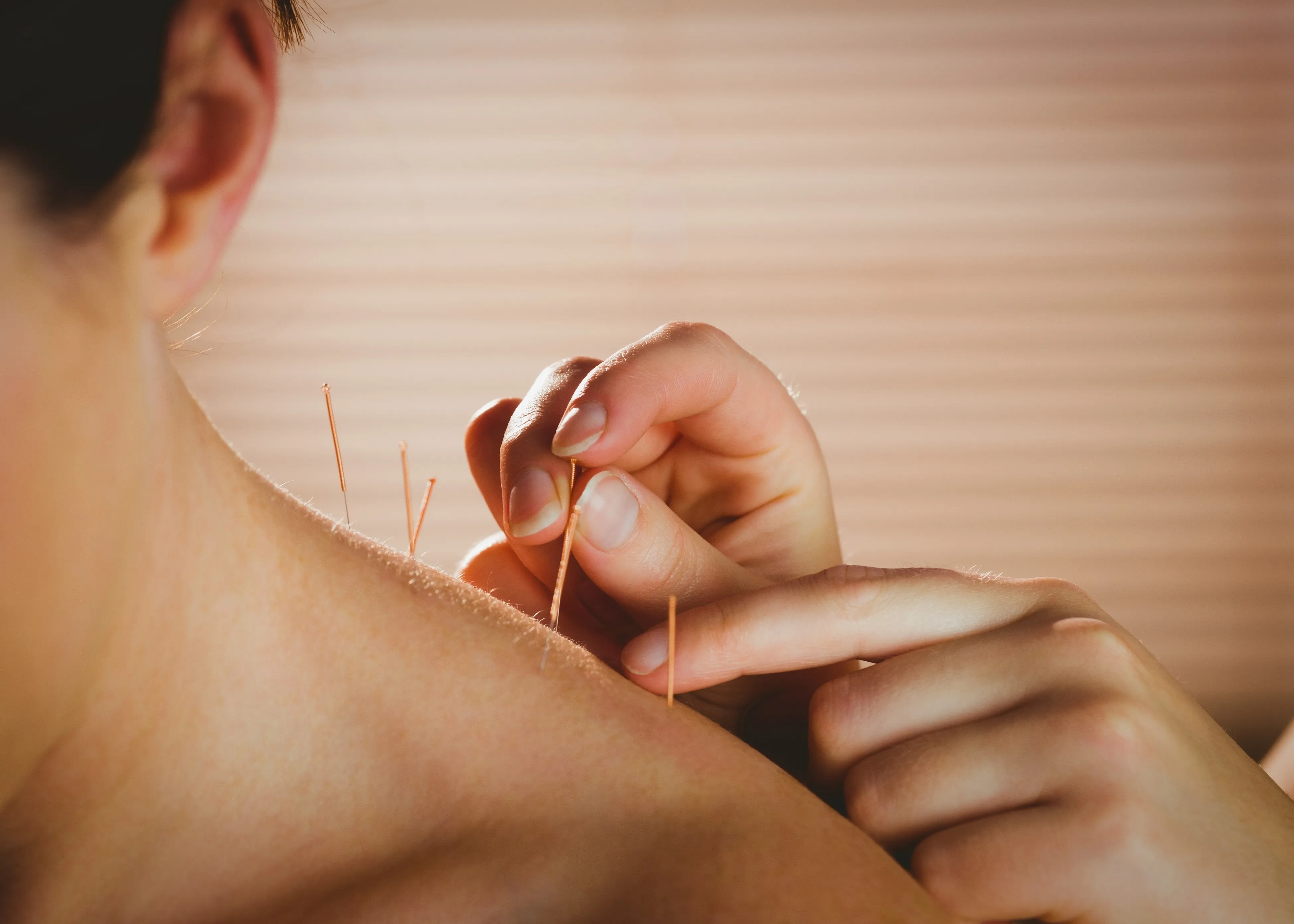 Acupuncture