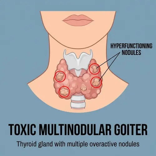 Toxic Multinodular Goiter