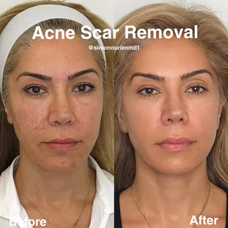 Understanding Acne Scars before & after picture