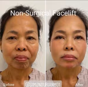 before and after facelift results for Epione patient