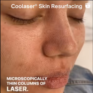 image of patient about to have Coolaser treatment