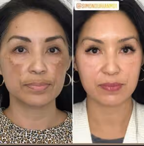 patient before and after her melasma Coolaser visit