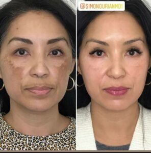 patient before and after her melasma Coolaser visit
