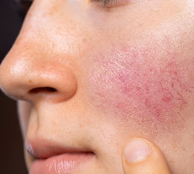 What Is Rosacea?