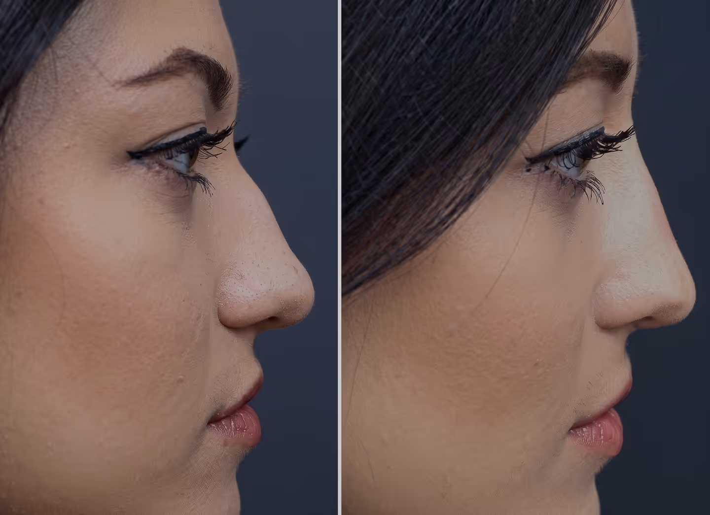 Non Surgical Nose Job