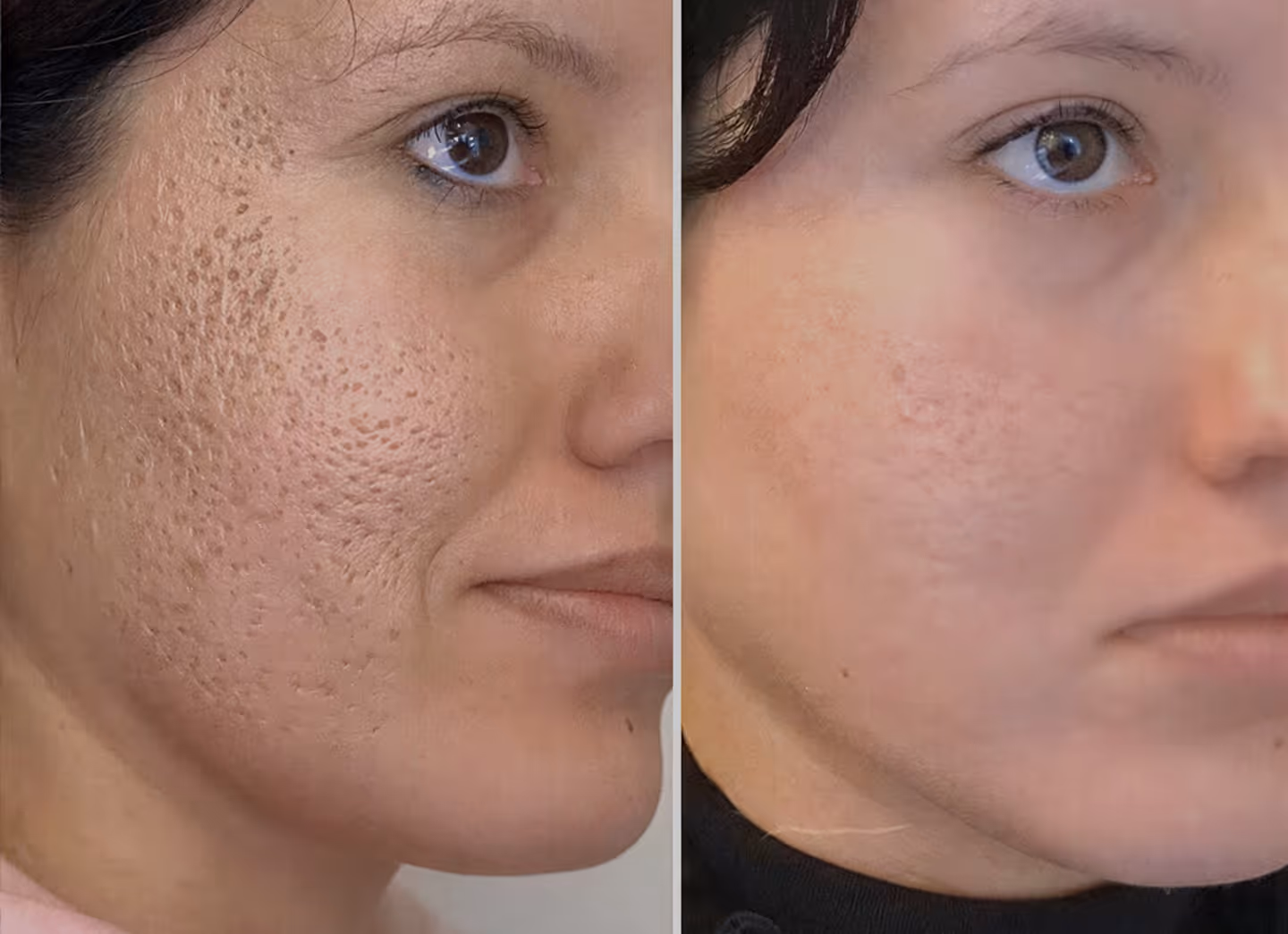 Skin Resurfacing