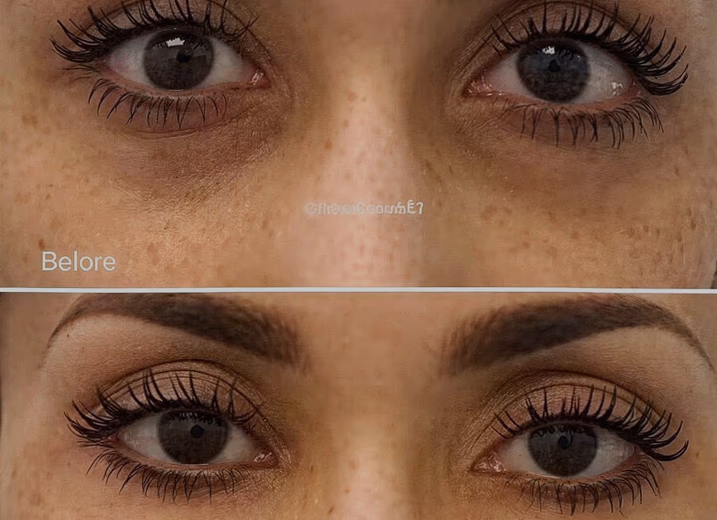 Dark Circles & Eye Bags