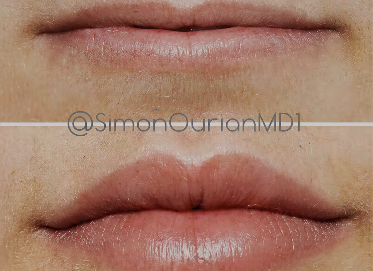 Lip Augmentation