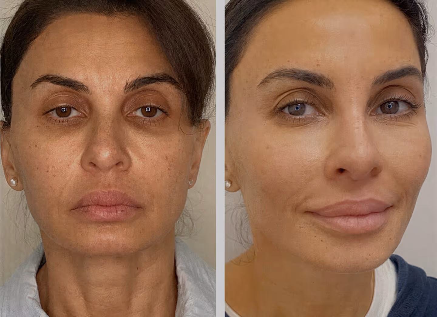 Non Surgical Facelift