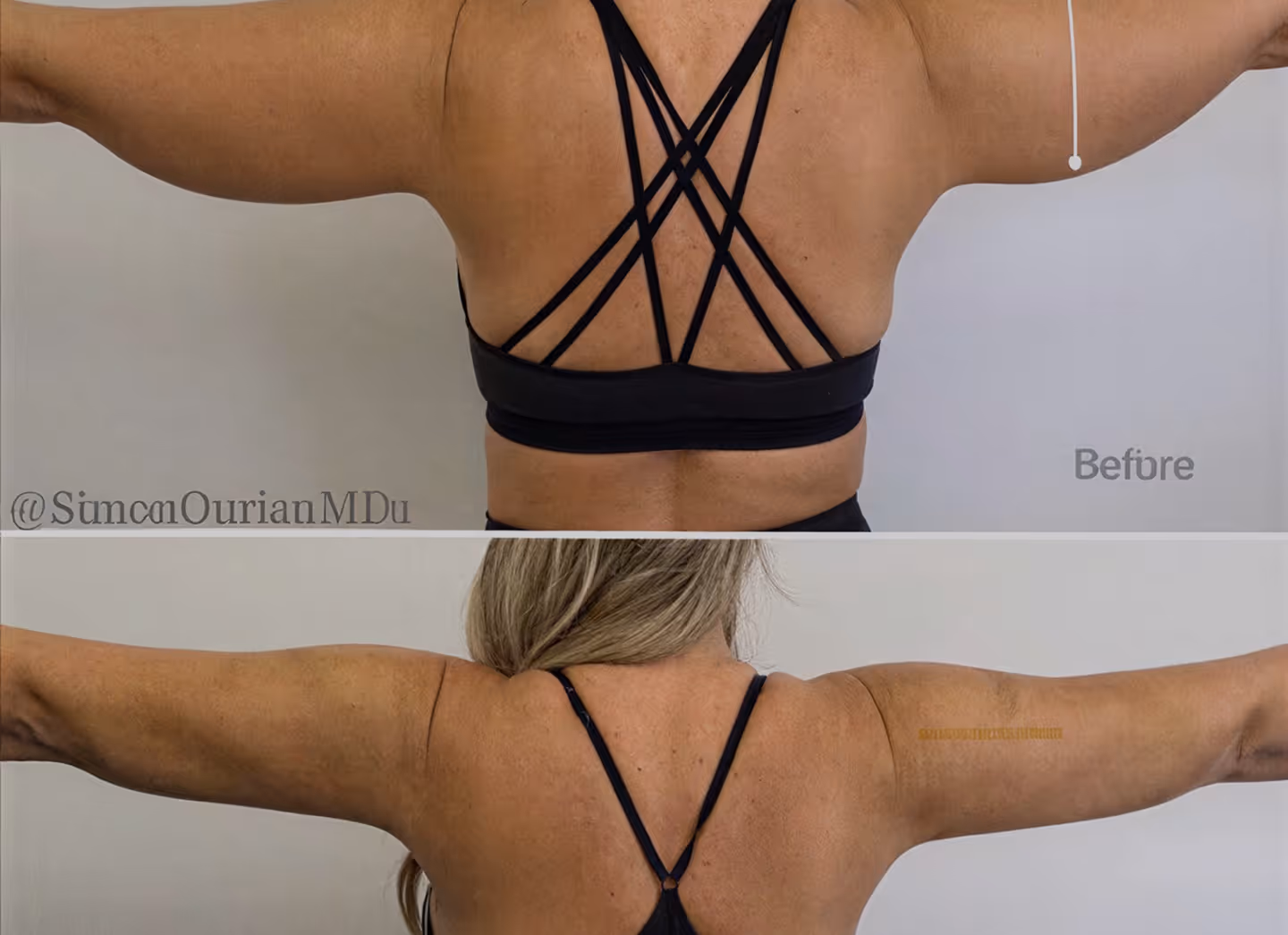 Non Surgical Arm Lift