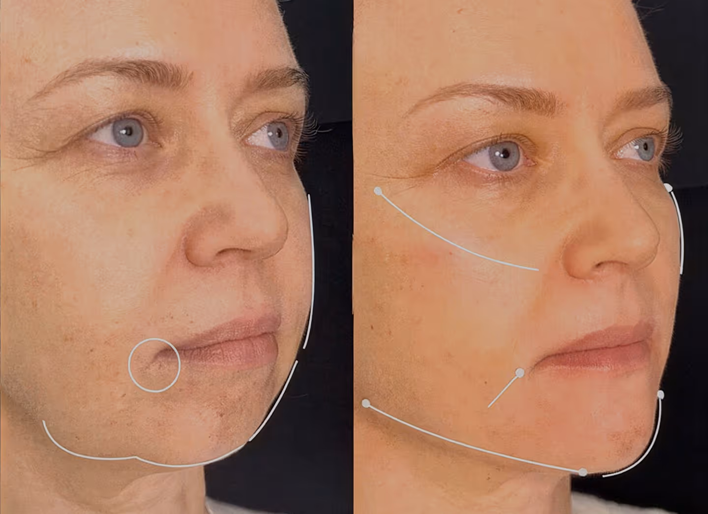 Facial Contouring
