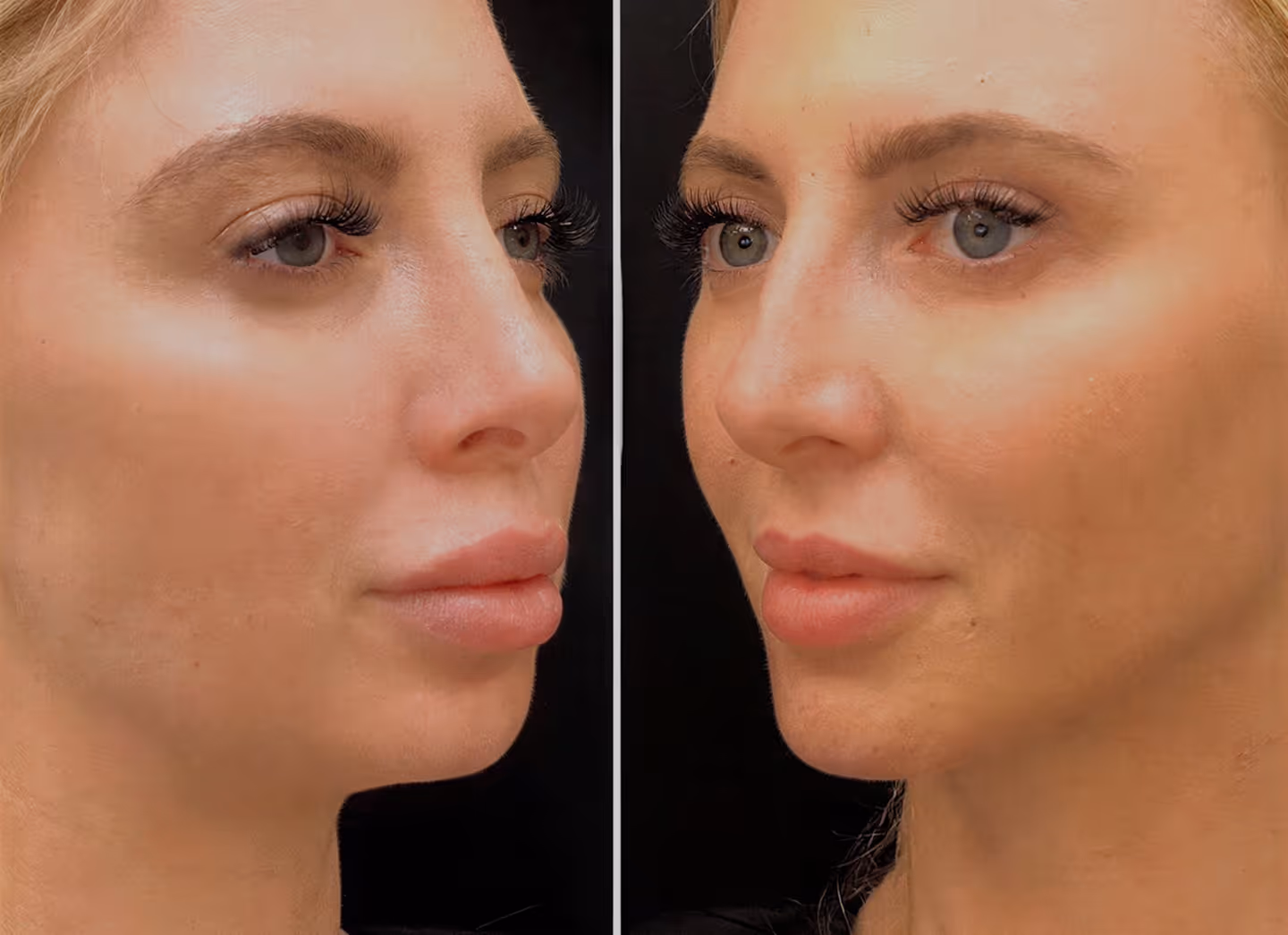 Chin Contouring