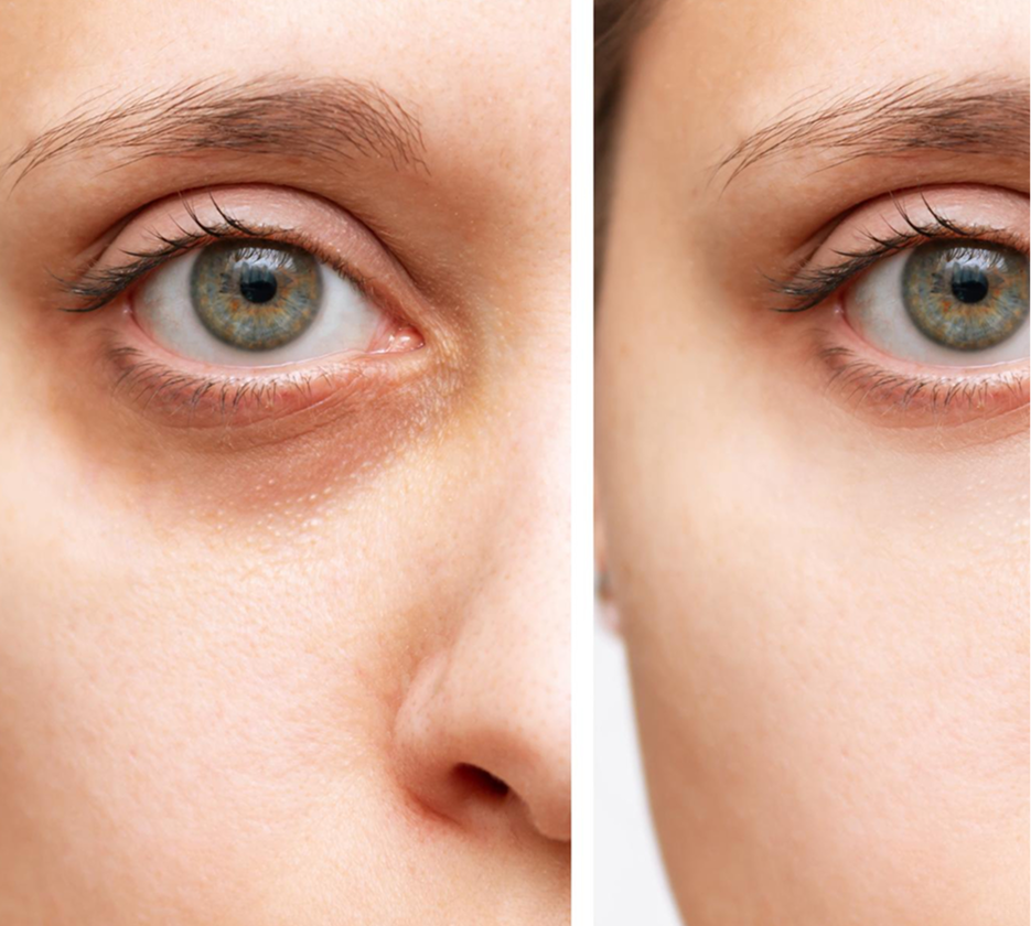 How Long Do Results Last?