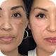 Age Spots Removal