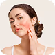 Rosacea Treatment
